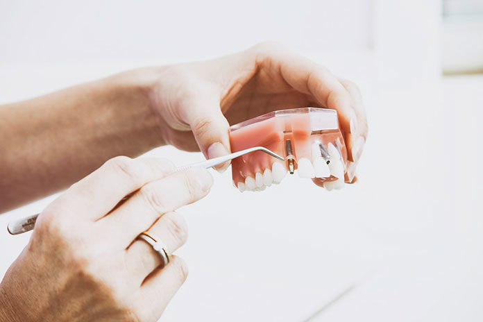 Implanty zębowe