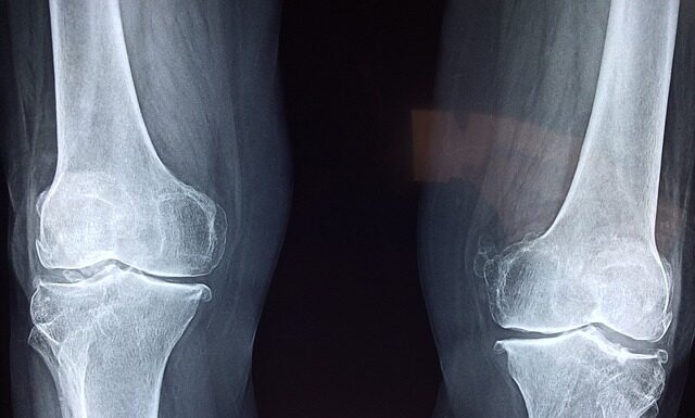 Co lepsze but ortopedyczny czy gips? Co lepsze but ortopedyczny czy gips?