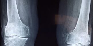 Czy but ortopedyczny można ściągać na noc?