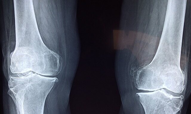Czy but ortopedyczny można ściągać na noc?